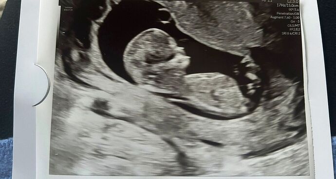 Baby scan